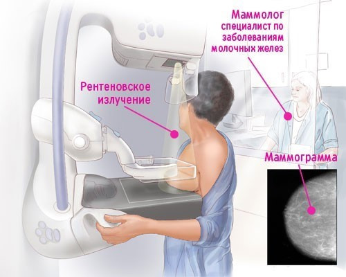 Что такое маммография?